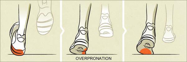 over-pronation